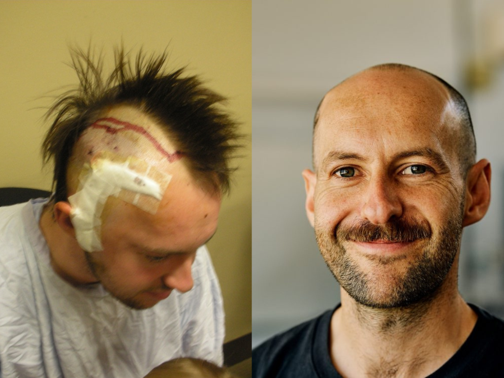 Man with head injuries bandaged on left. Head shot of man, smiling on right.